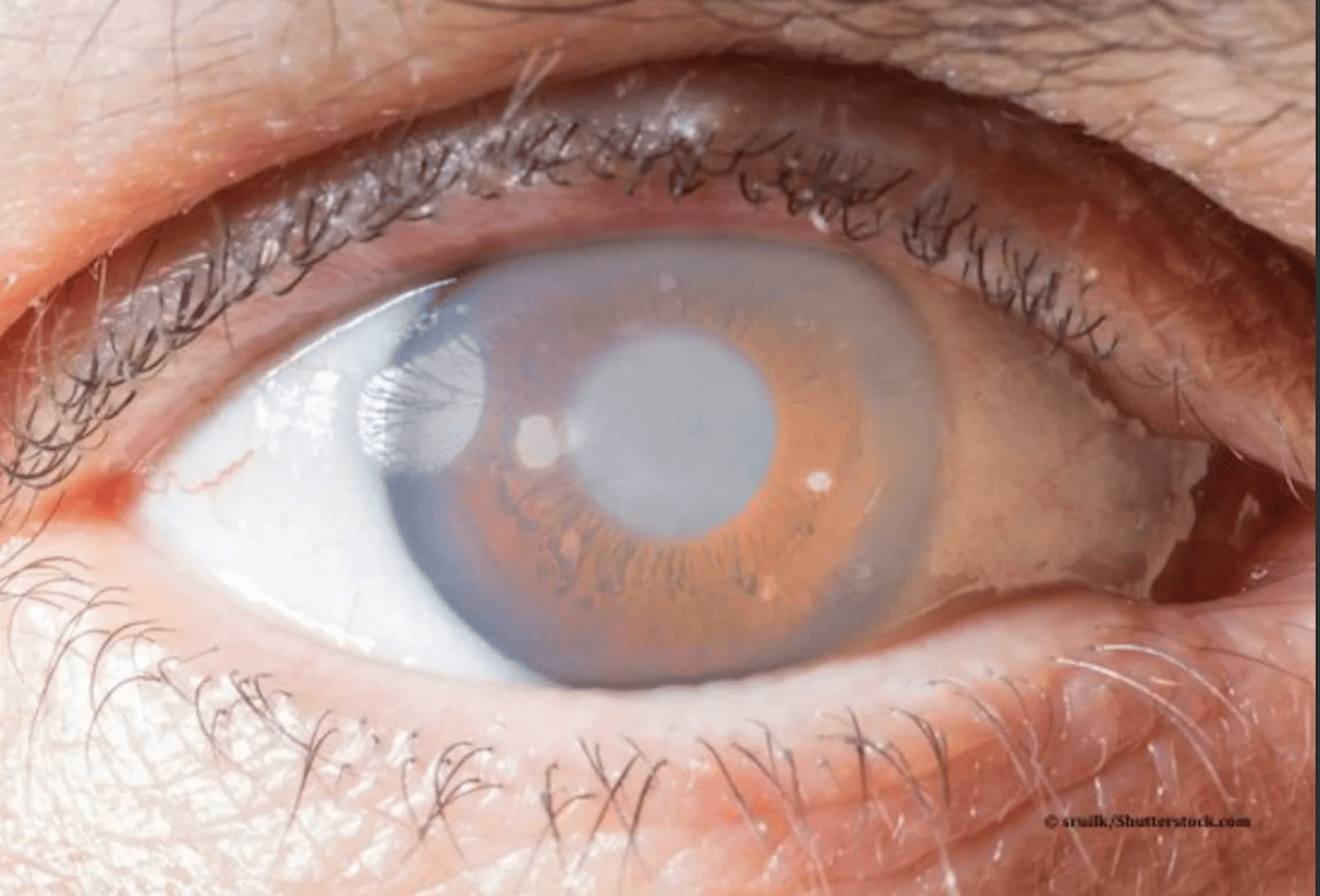 Close-up of an eye showing glaucoma symptoms