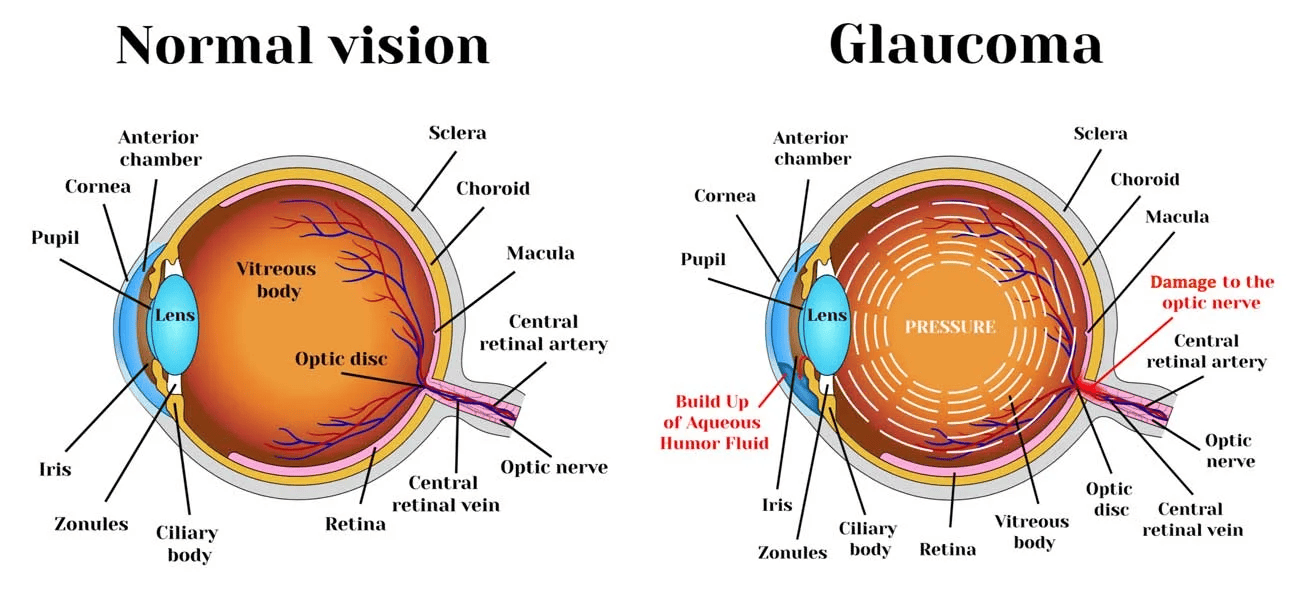 Normal vs Glaucoma Eye Diagram