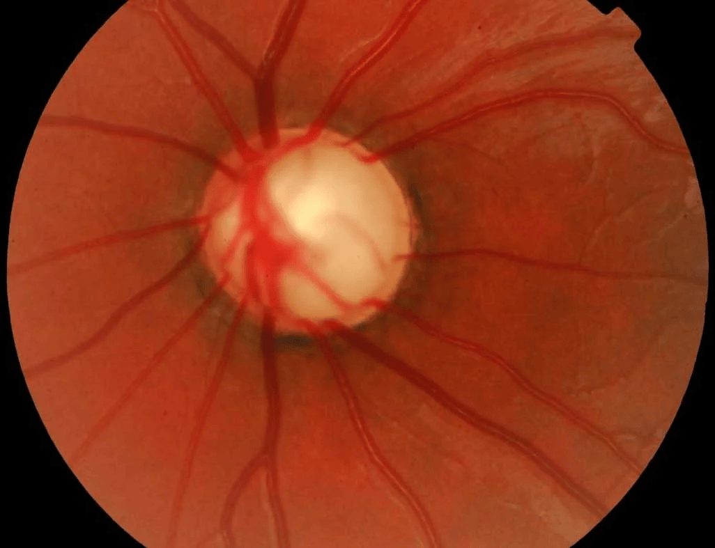 Glaucoma optic nerve example