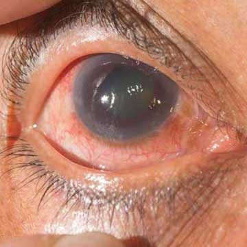 Vitreoretinal