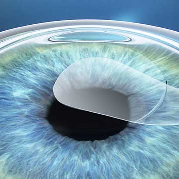 Cornea