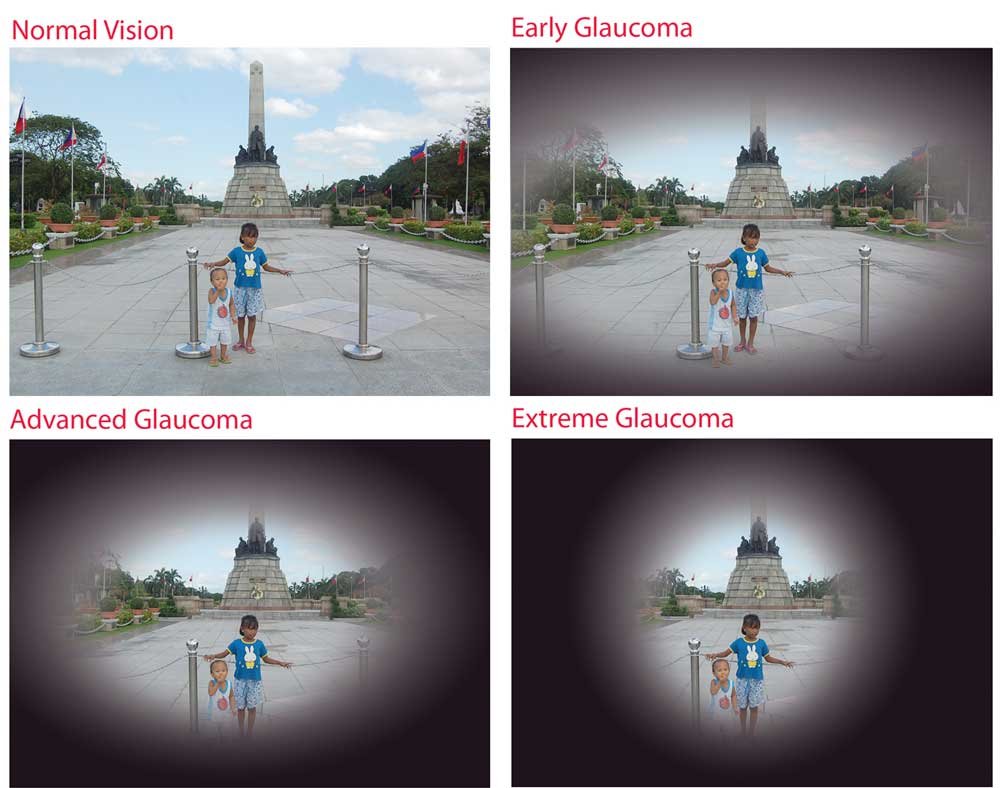 glaucoma-progression