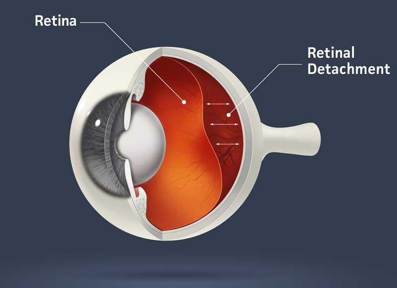 retinal-detachment